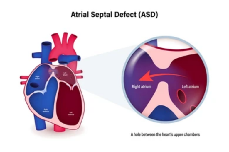 Atrial Septal Defect (ASD)