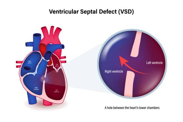 Ventricular Septal Defect (VSD)