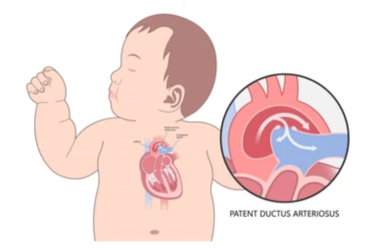 Patent Ductus Arteriosus (PDA)