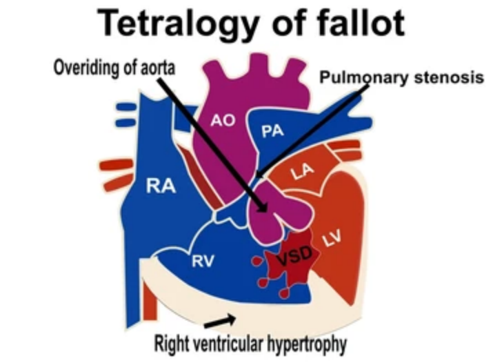Tetralogy of Fallot (TOF)