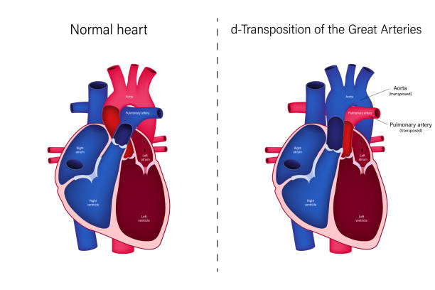 Transposition of the Great Arteries (TGA)