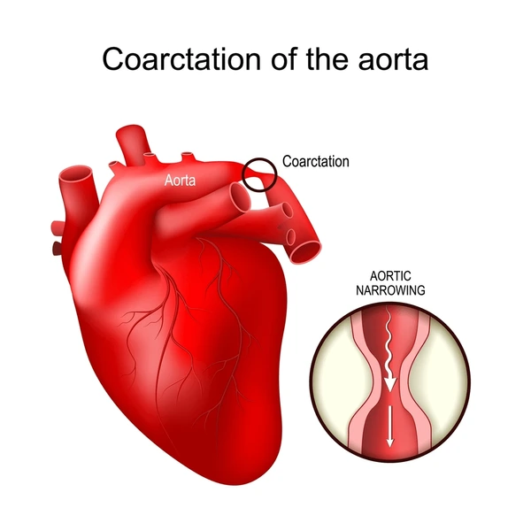 Coarctation of the Aorta