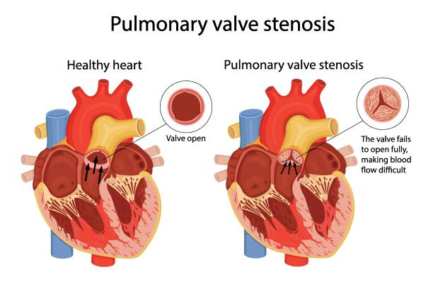 Pulmonary Stenosis