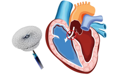 Atrial Septal Defect ASD Closure - Dr Prashant Bobhate