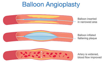 Balloon Angioplasty and Stenting - Dr Prashant Bobhate