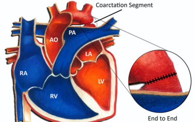 Coarctation of the Aorta Repair - Dr Prashant Bobhate