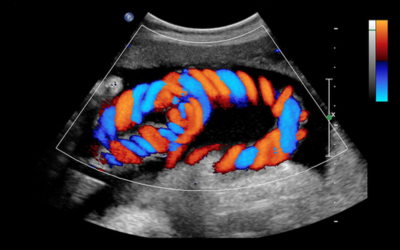 Congenital Mitral Valve Stenosis