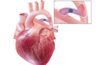 Patent Ductus Arteriosus PDA Closure - Dr Prashant Bobhate