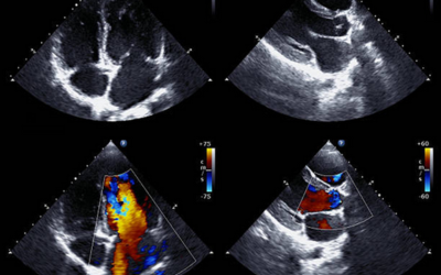 Aortic Valve Stenosis