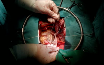 Aortic Valve Stenosis