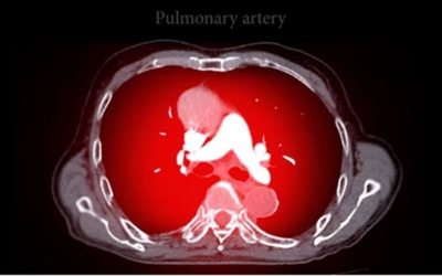 CT Pulmonary Angiography CTPA - Dr Prashant Bobhate Aortic Valve Stenosis
