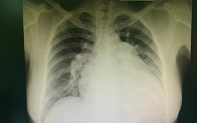 Chest X-Ray - Dr Prashant Bobhate Pulmonary Valve Stenosis