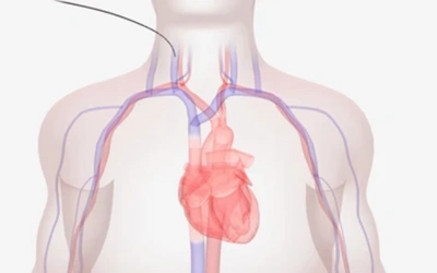 Right Heart Catheterization - Dr Prashant Bobhate Aortic Valve Stenosis