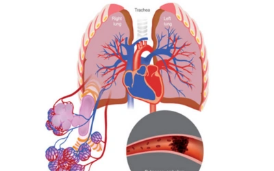Atrial Septostomy _ Atrial Flow Regulator AFR 1 - Dr Prashant Bobhate