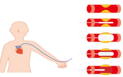 Right Heart Catheterization 1 - Dr Prashant Bobhate