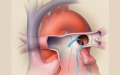 Transcatheter Potts Shunt 1 - Dr Prashant Bobhate